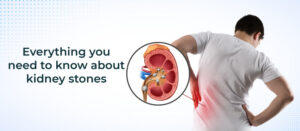 What Causes Kidney Stones