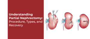 Understanding Partial Nephrectomy: Procedure, Types, and Recovery