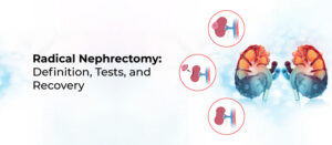 Radical Nephrectomy: Definition, Tests, and Recovery