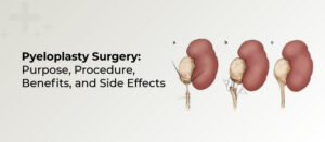 Pyeloplasty Surgery: Purpose, Procedure, Benefits, and Side Effects