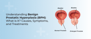 Understanding Benign Prostatic Hyperplasia (BPH): What is it? Causes, Symptoms, and Treatments