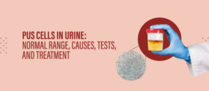 Pus Cells in Urine: Normal Range, Causes, Tests, and Treatment