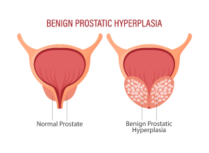Benign Prostatic Hyperplasia